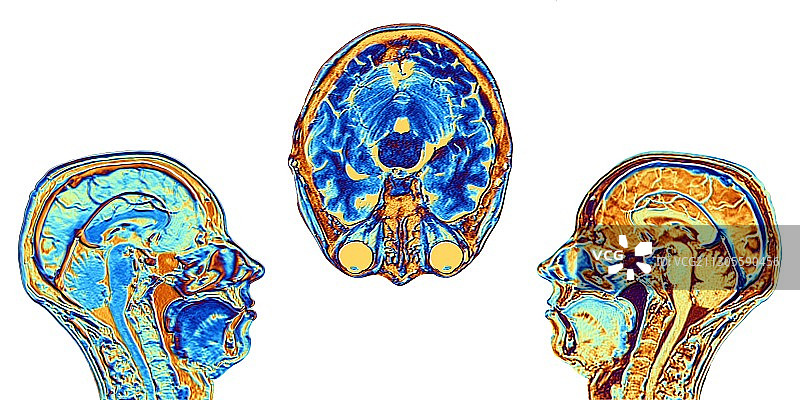 正常大脑的MRI扫描，图示图片素材