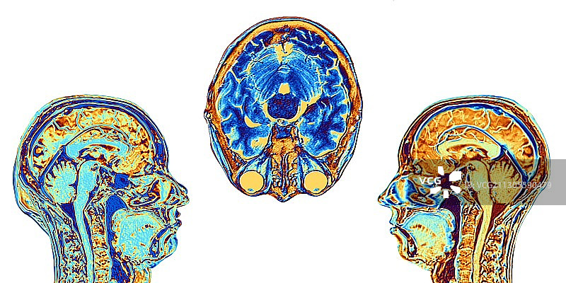 正常大脑的MRI扫描，图示图片素材