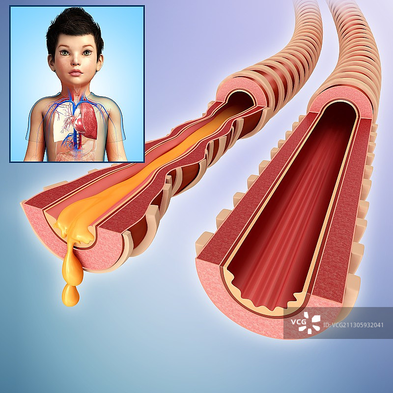儿童感染和正常支气管，图示图片素材