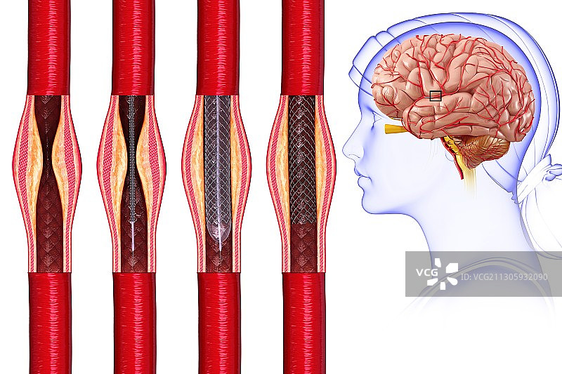 中风治疗插画图片素材