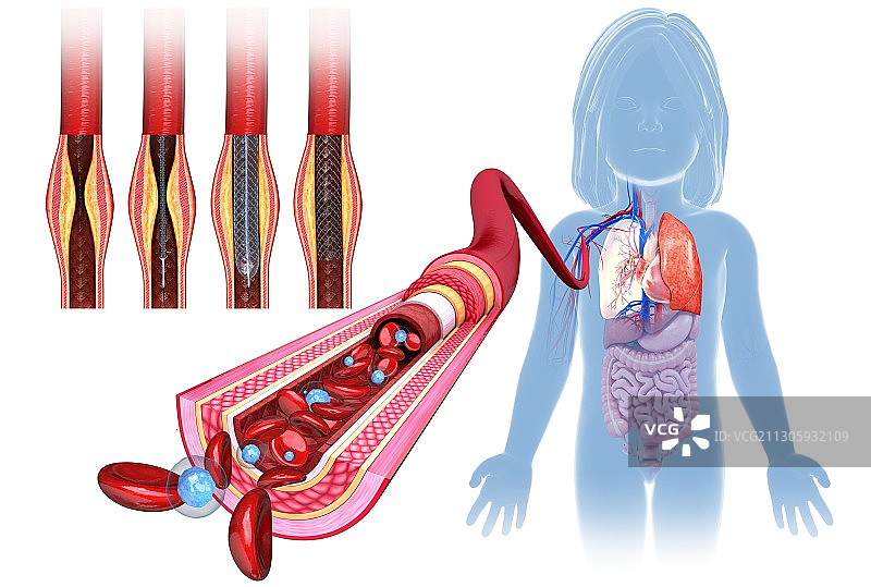 动脉阻塞支架治疗插图图片素材