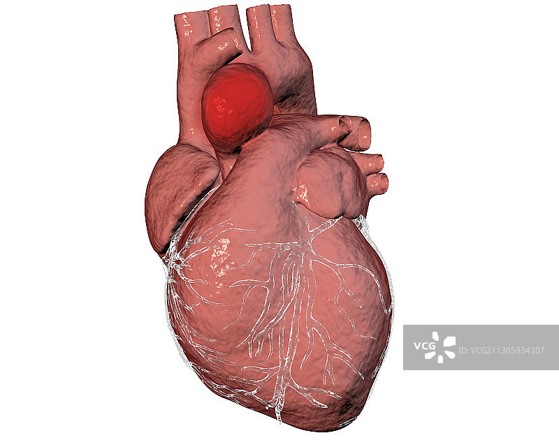 主动脉动脉瘤插图图片素材