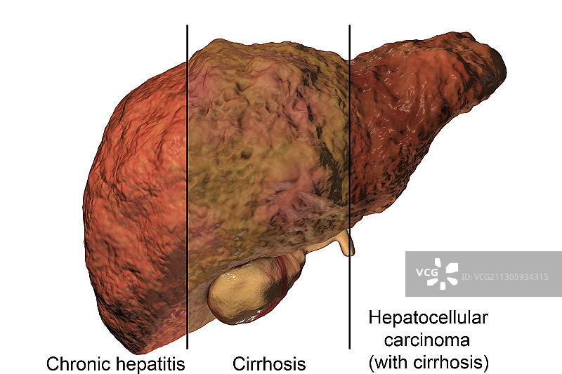 肝脏疾病的各个阶段图示图片素材