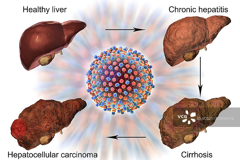 丙型肝炎引起的肝病各阶段图示图片素材