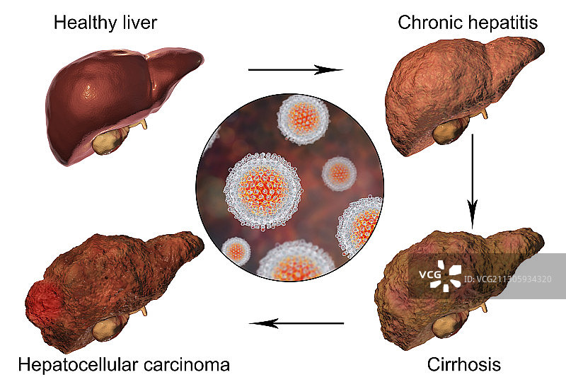 丙型肝炎引起的肝病各阶段图示图片素材