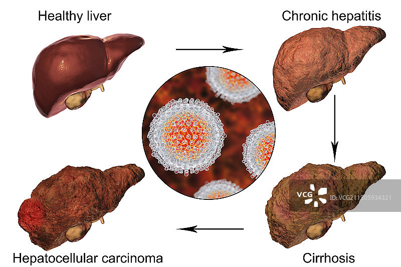 丙型肝炎引起的肝病各阶段图示图片素材