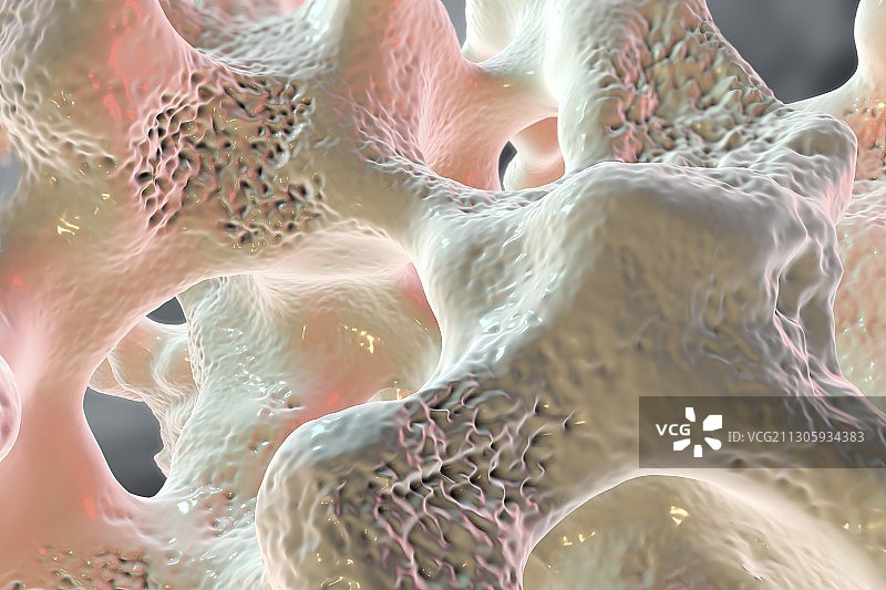 骨质疏松症，图示图片素材