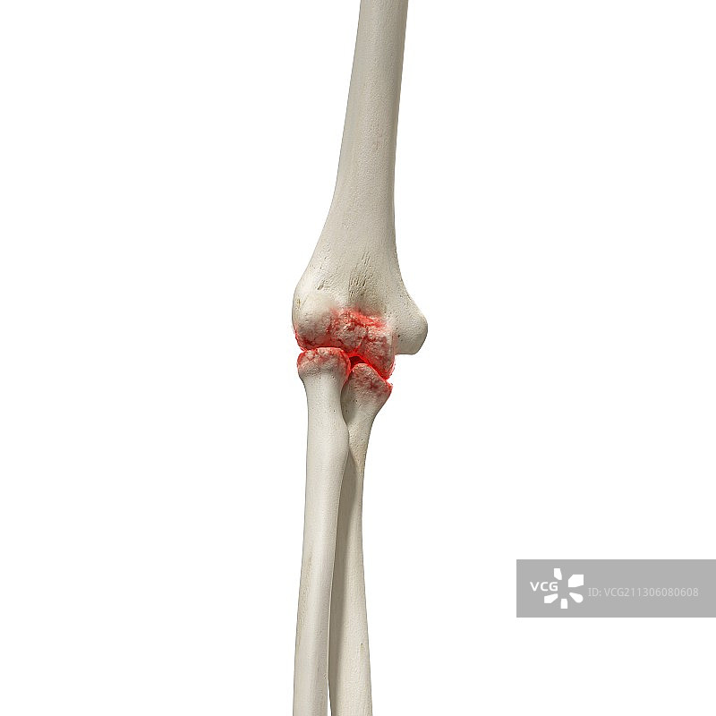 肘部关节炎插图图片素材