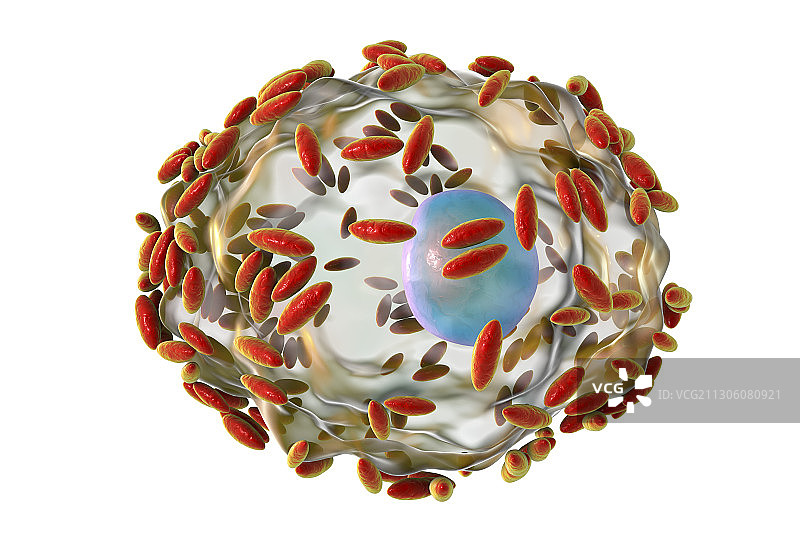 细菌性阴道病，图示图片素材