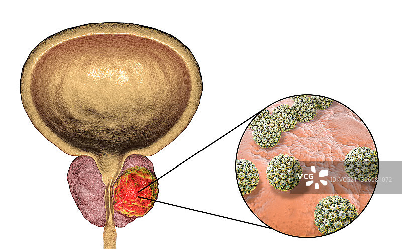 前列腺癌的病毒病因概念图图片素材