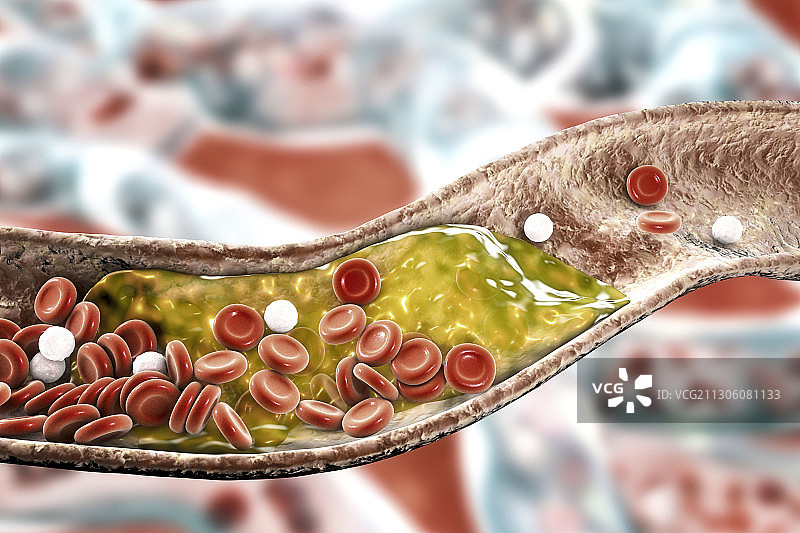 动脉粥样斑块插图图片素材