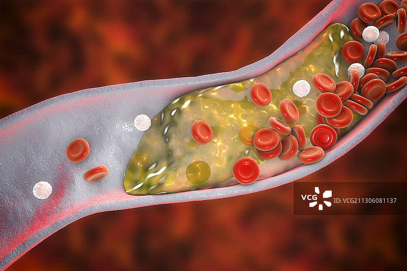 动脉粥样斑块插图图片素材