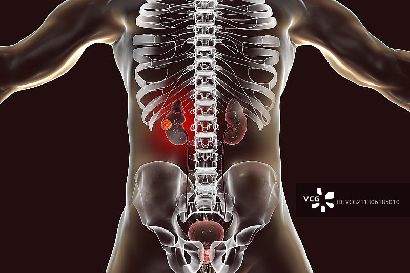 肾癌图示图片素材