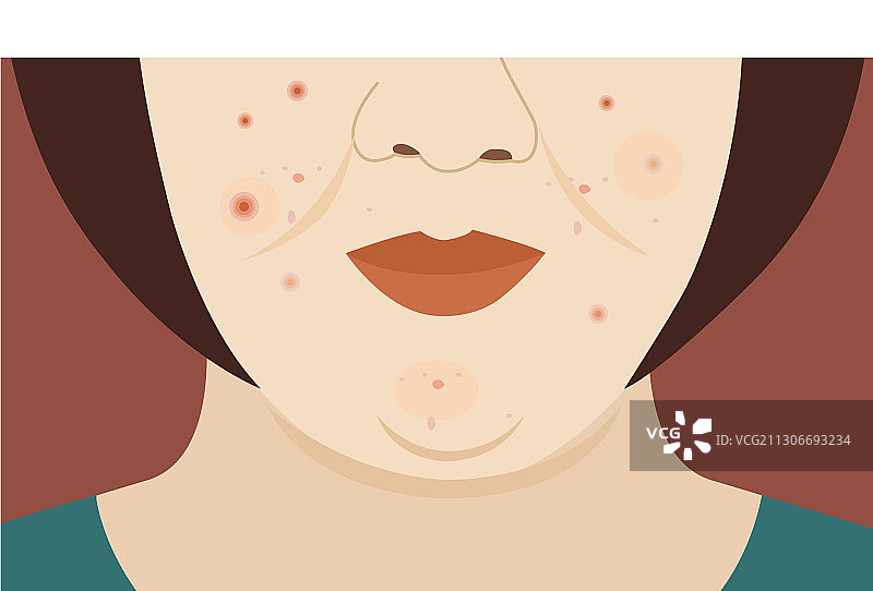 女性面部过敏皮疹和红色水疱图片素材