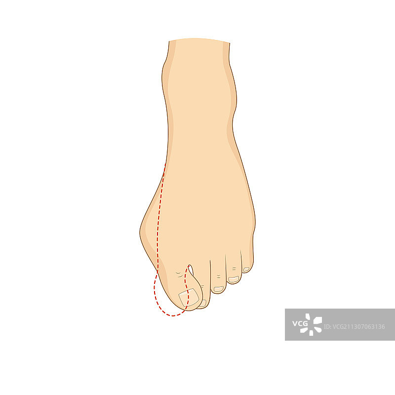 拇外翻手术矫正图片素材