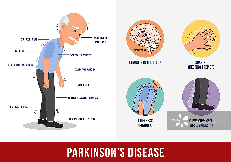 帕金森病图片素材