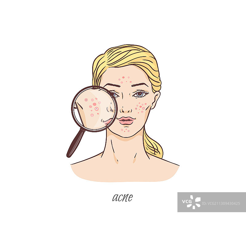 放大镜下的卡通女人痤疮皮肤问题图片素材