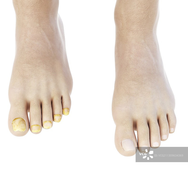脚趾甲真菌插画图片素材