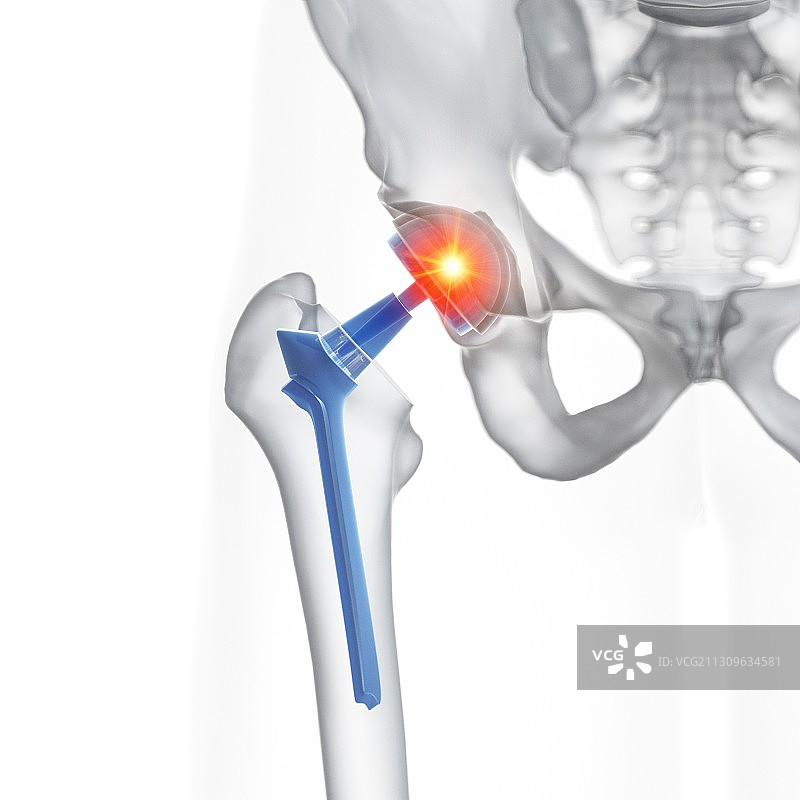 髋关节置换插画图片素材