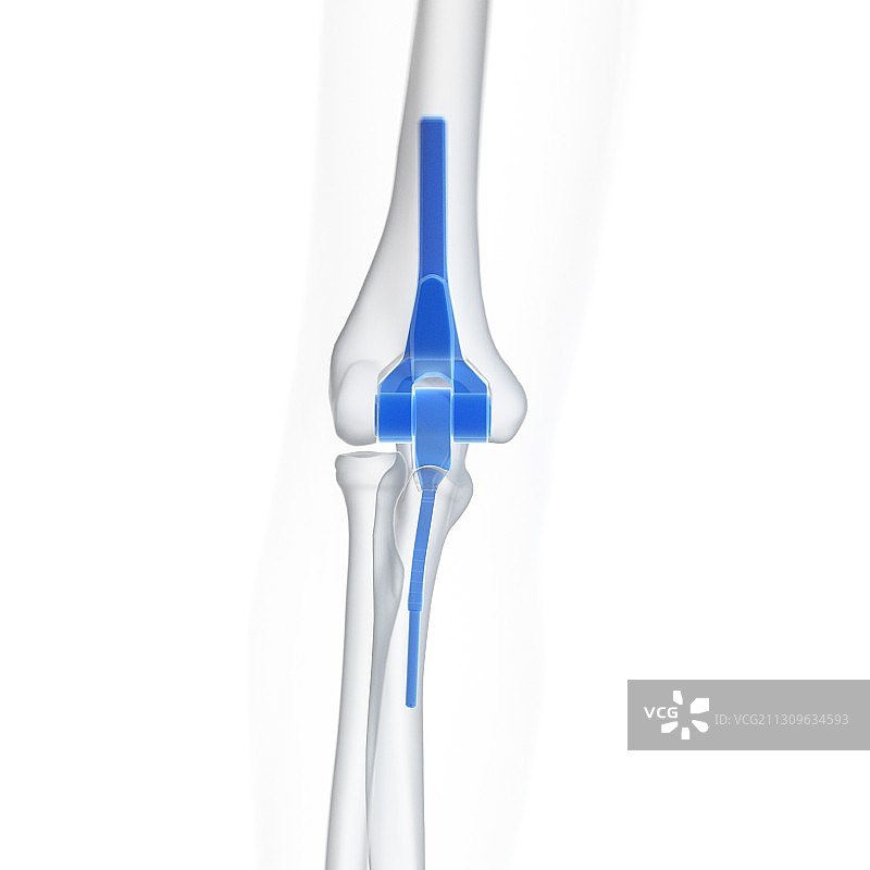 肘关节置换术图示图片素材