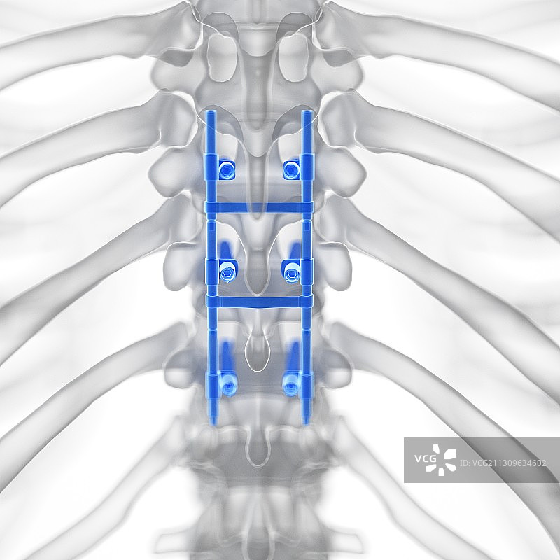 脊柱融合术插图图片素材