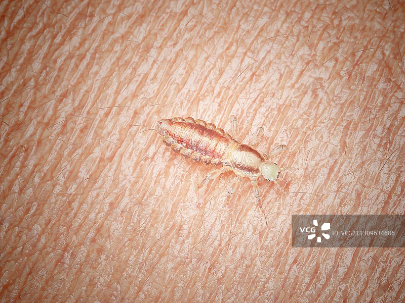 人皮肤上的头虱插画图片素材