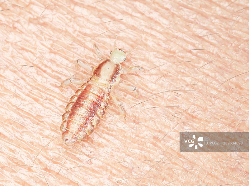 人皮肤上的头虱插画图片素材