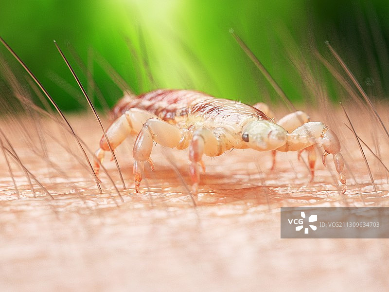 人皮肤上的头虱插画图片素材