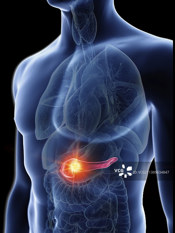 男人胰腺肿瘤的插图图片素材