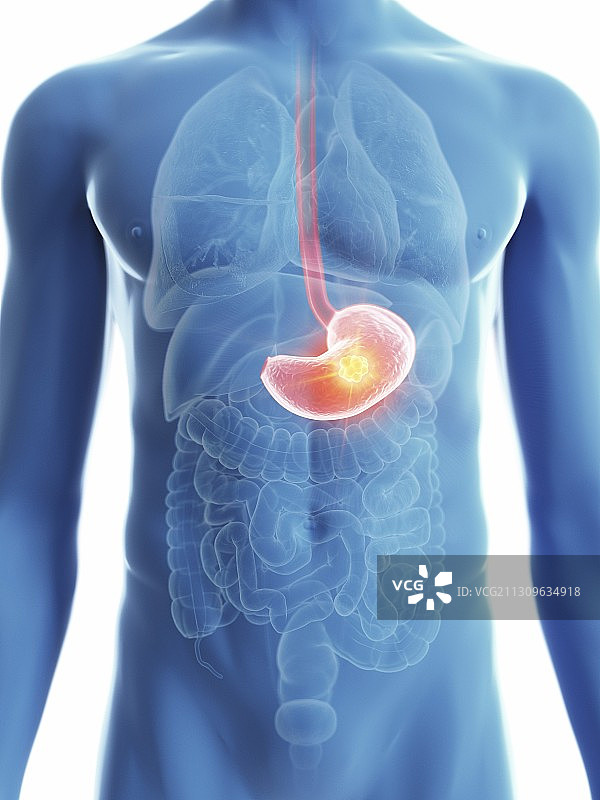 男人胃癌插画图片素材