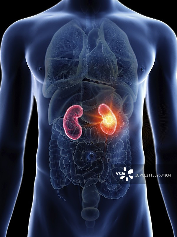 男人肾癌插画图片素材