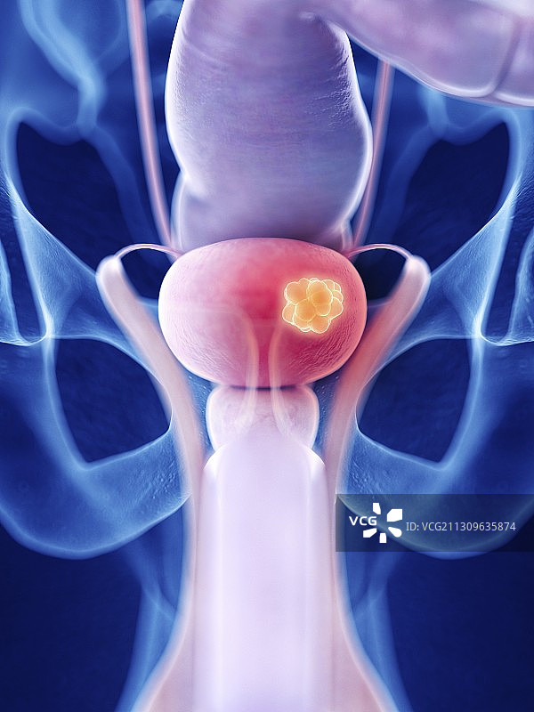 膀胱癌插画图片素材