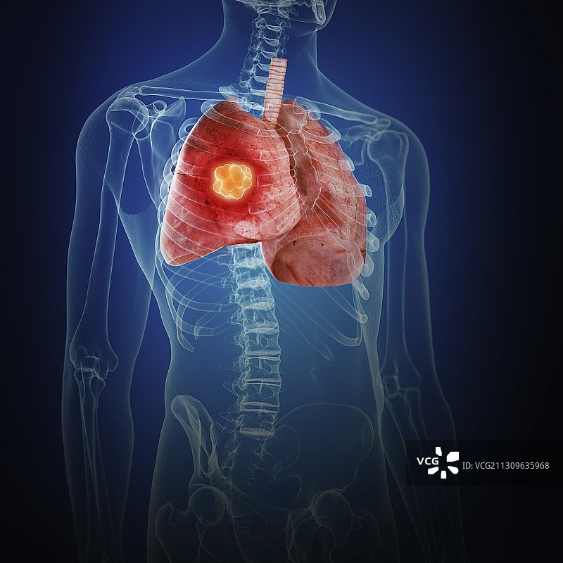 肺癌插画图片素材