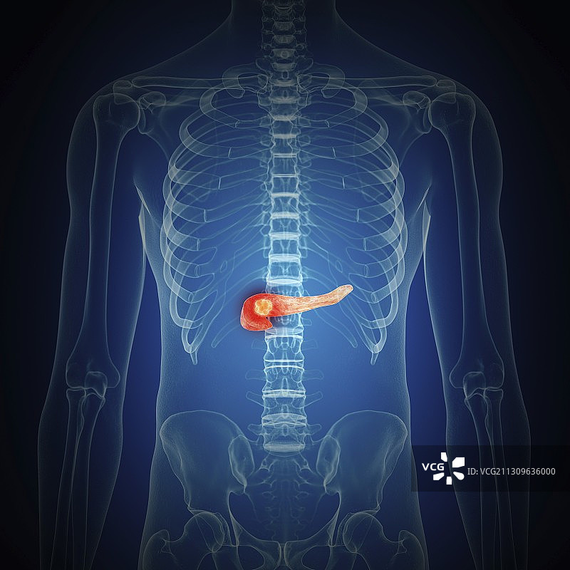 胰腺癌插画图片素材