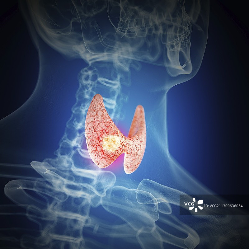 甲状腺癌图示图片素材
