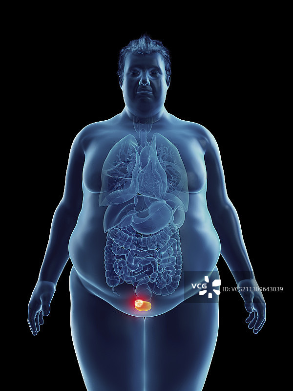 肥胖男子膀胱肿瘤插画图片素材