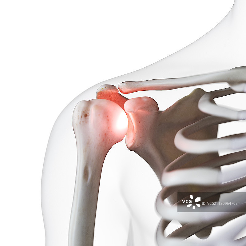 肩关节疼痛插画图片素材