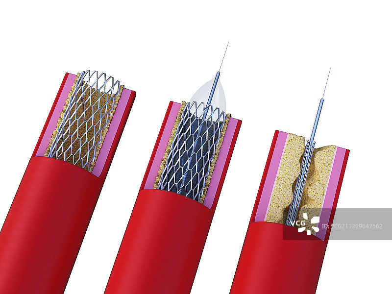 支架植入过程插画图片素材