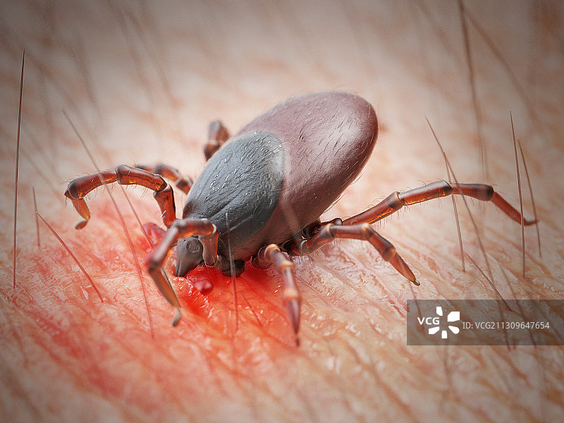 蜱虫叮咬人皮肤的插画图片素材