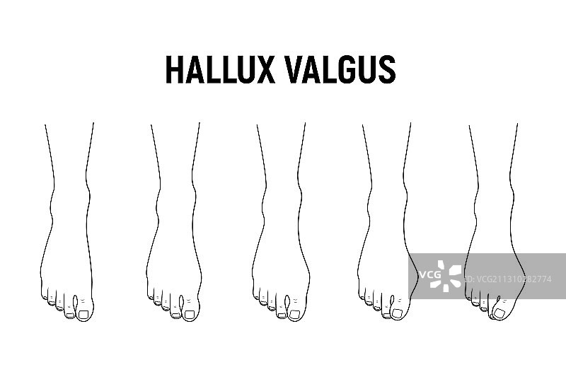 拇外翻疾病阶段图片素材