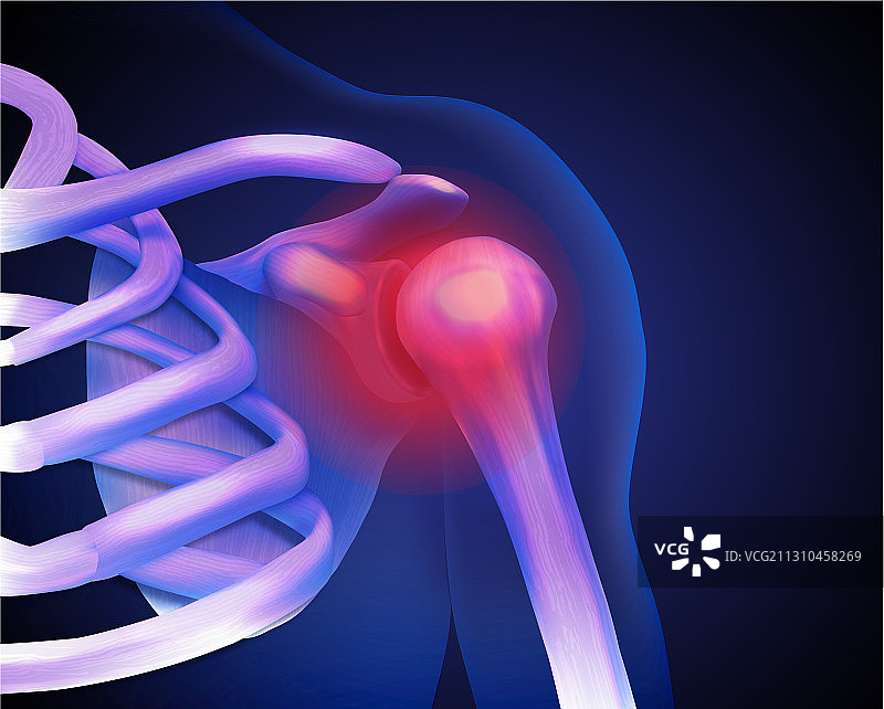 人肩关节炎症图片素材