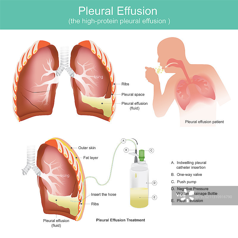 肺部结核病感染患者图片素材