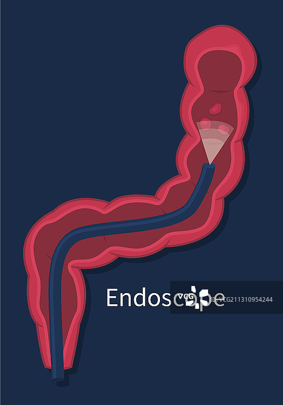 内镜在结肠息肉筛查中的应用图片素材