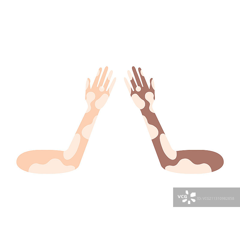 患有白癜风皮肤病的双手图片素材