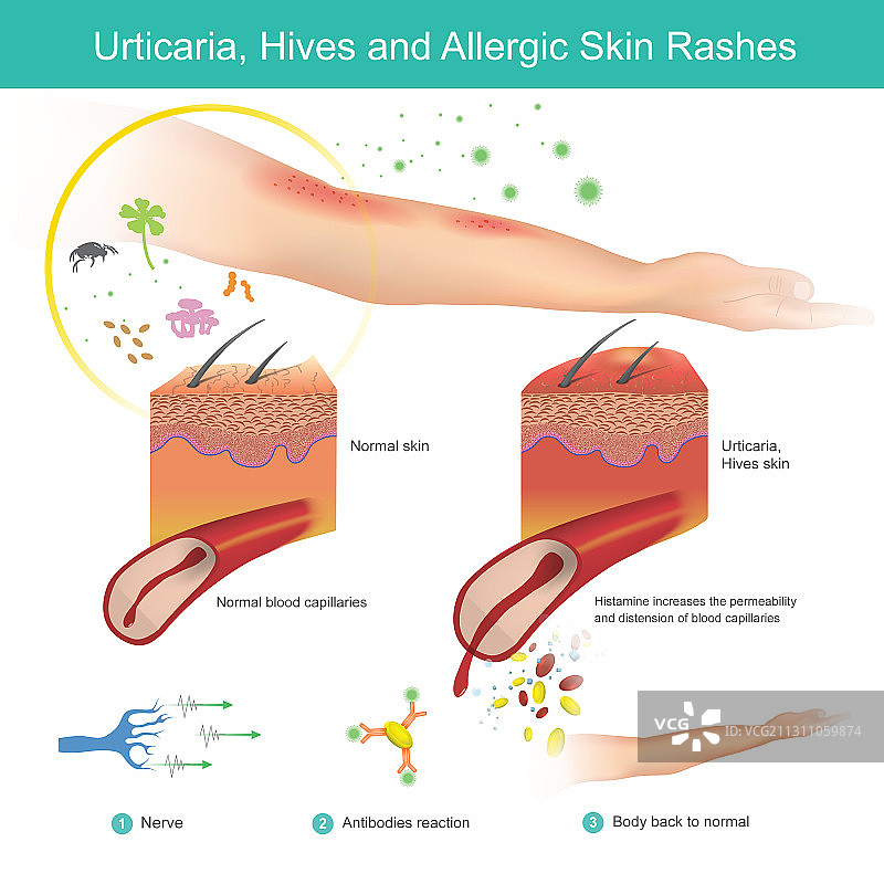 荨麻疹和过敏性皮疹图片素材