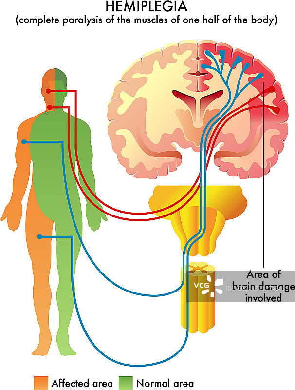 偏瘫海报图片素材