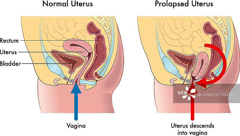 子宫脱垂图片素材