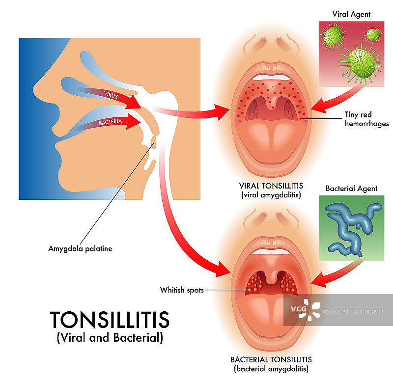 扁桃体炎图片素材