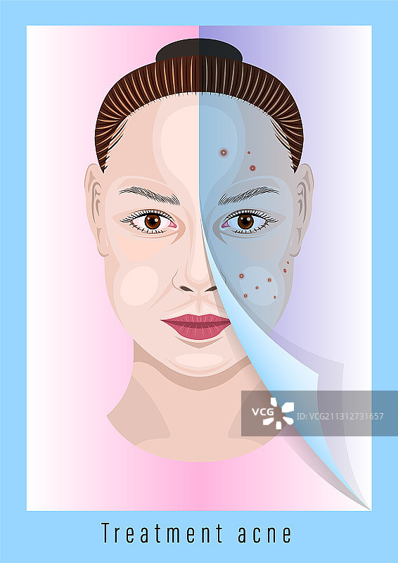 女性面部痤疮治疗前后对比图片素材