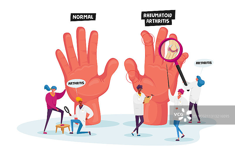 类风湿关节炎概念图：微型医生图片素材